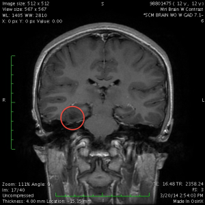MRI with contrast